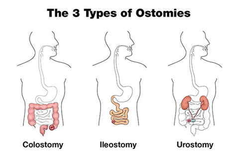3 Types of Ostomies or Stomas