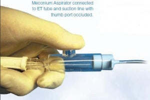 Meconium Aspirators