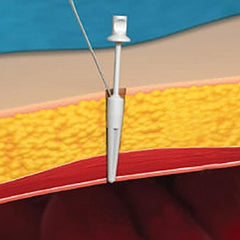 Joystick Laparoscopic Port Closure System